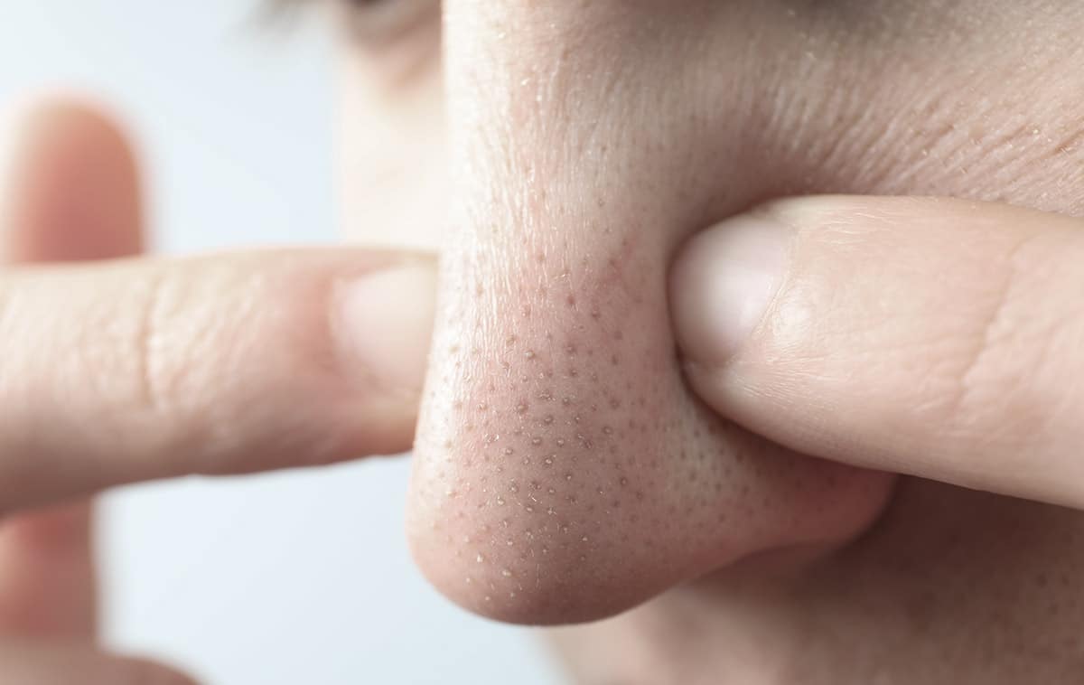 Points noirs sur le nez : comment les enlever ? | Barbedudaron.fr