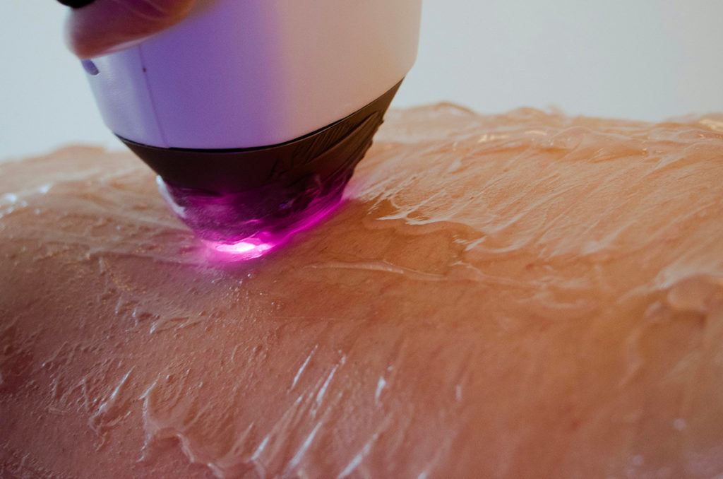 épilation laser pour homme