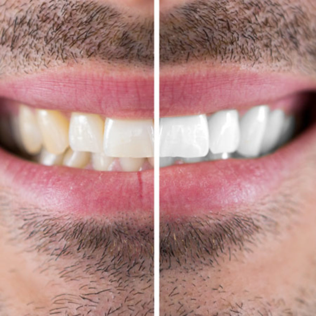 Blanchiment Homme dents