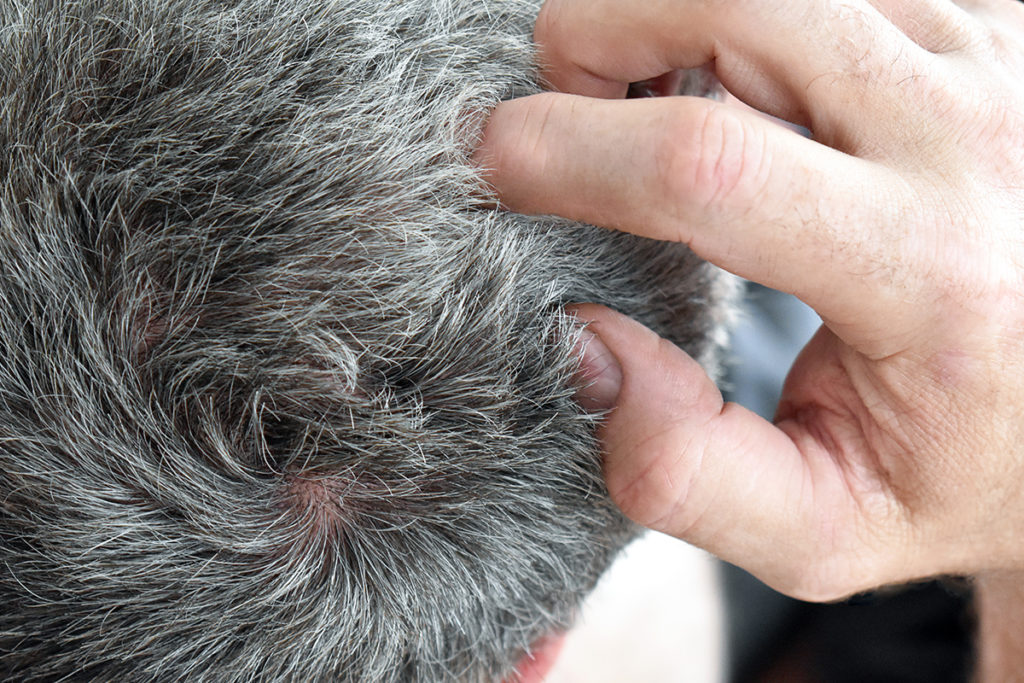 Démangeaisons Cuir chevelu