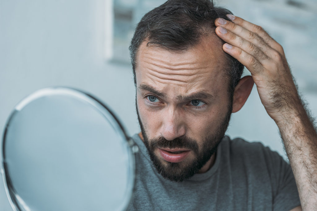 Pourquoi les hommes perdent leurs cheveux ?
