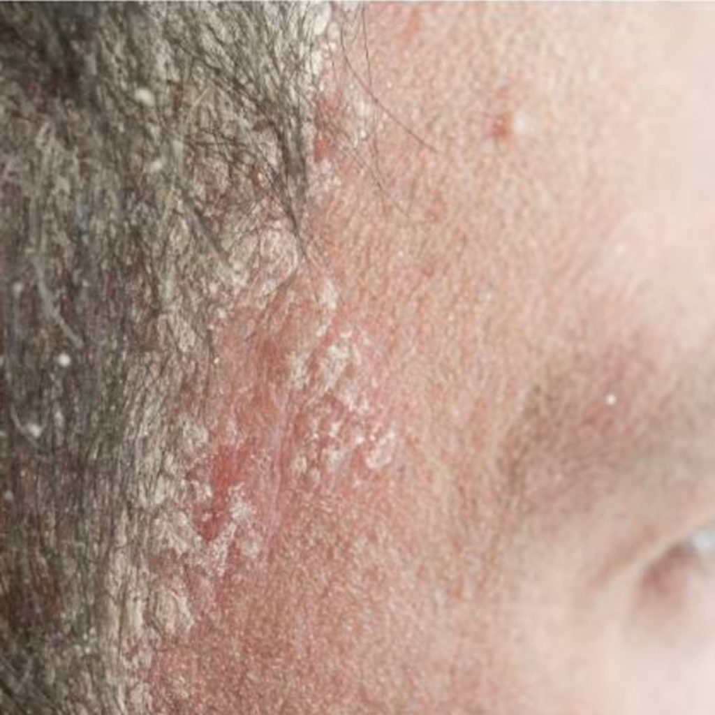 Psoriasis - Cuir chevelu