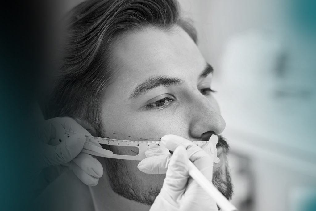 greffe de barbe