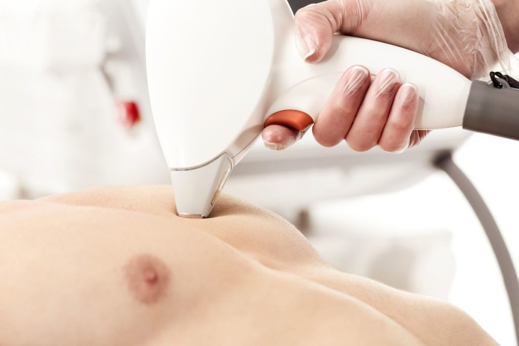 Epilation laser pour homme