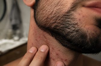 Poils incarnés dans la barbe