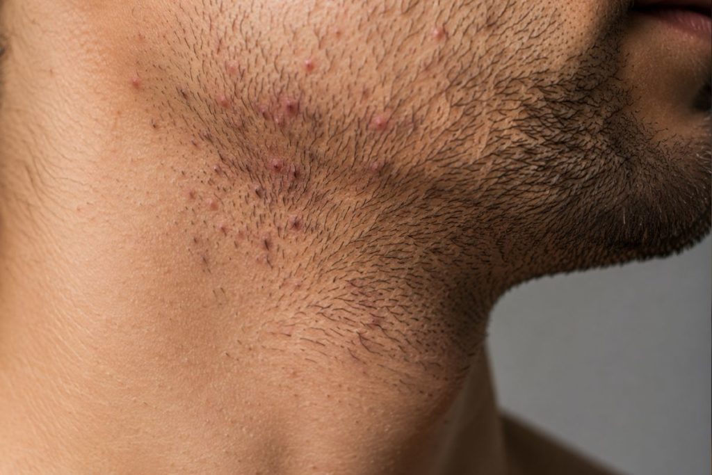 Poils incarnés au niveau de la barbe : la stratégie pour sauver votre peau 1 Poils incarnés dans la barbe
