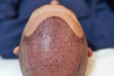 Cheveux, barbe, ligne frontale : quel style après une greffe ?