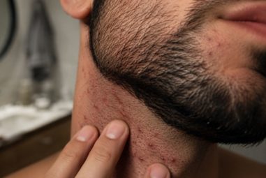 Poils incarnés au niveau de la barbe : la stratégie pour sauver votre peau